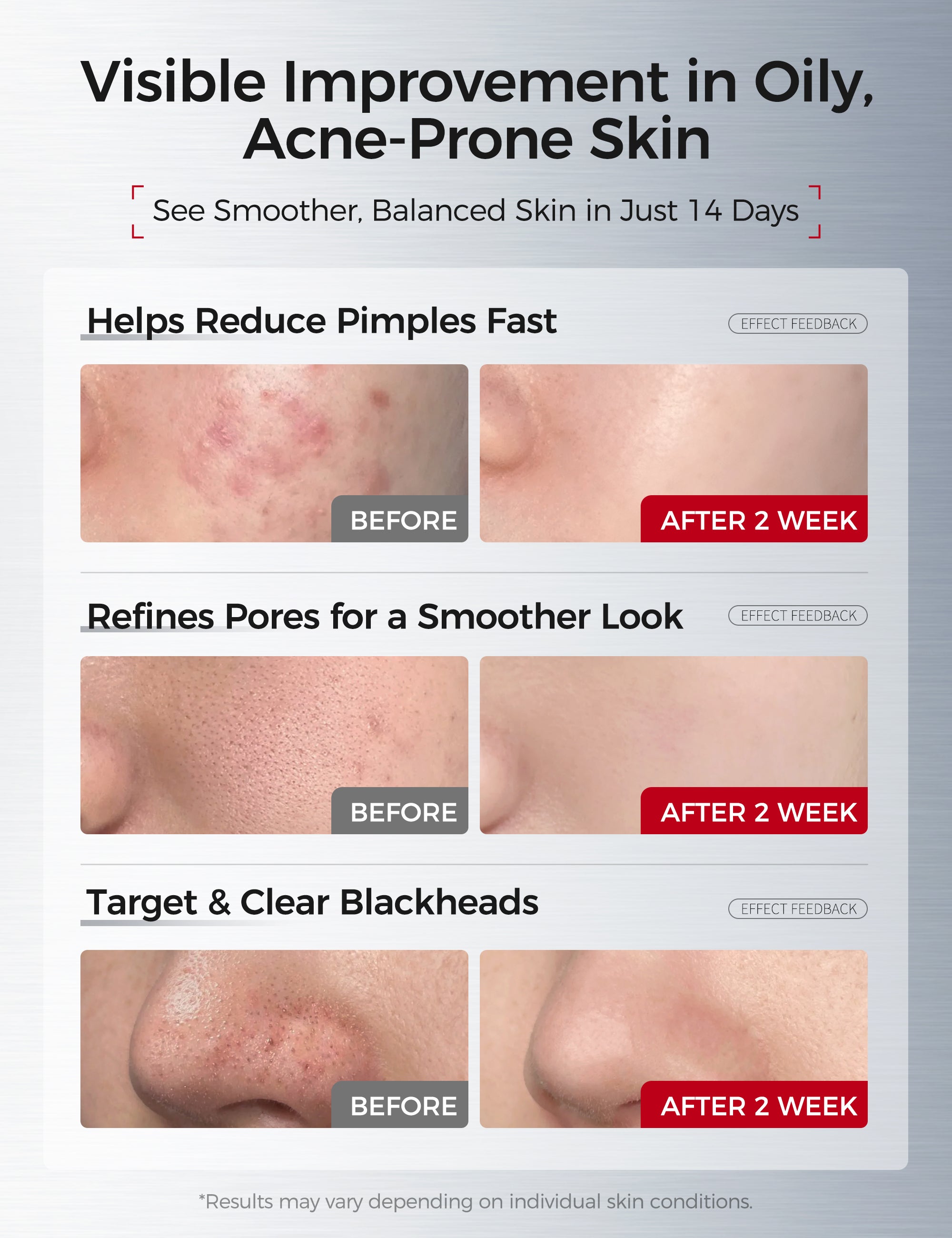 Salicylic Acid Acne Serum