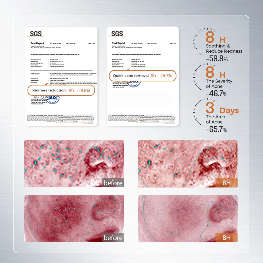 Anti-Acne Skin Repair Serum 1.5ml x 20 Single-Use Essence with 2% Encapsulated Salicylic Acid, Niacinamide & Soothing Complex
