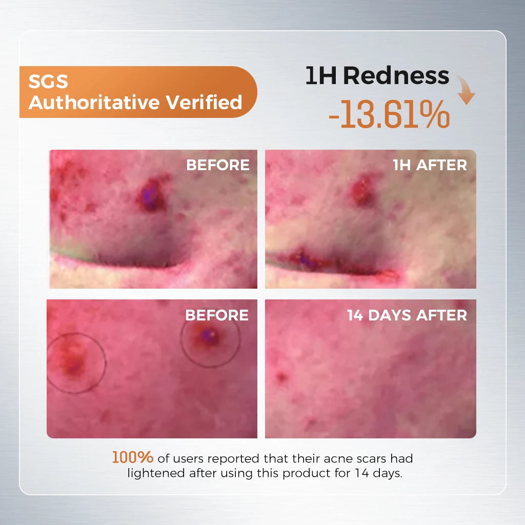 Anti-Acne Skin Repair Serum 1.5ml x 20 Single-Use Essence with 2% Encapsulated Salicylic Acid, Niacinamide & Soothing Complex