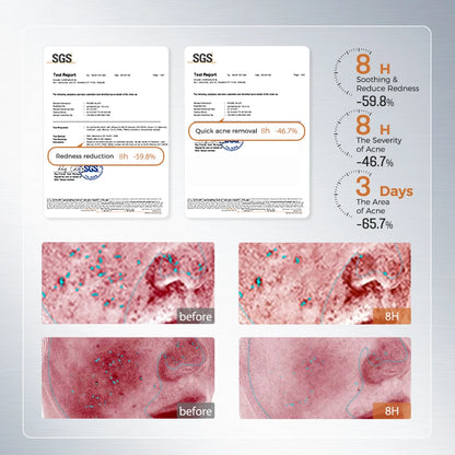 Anti-Acne Skin Repair Serum 1.5ml x 20 Single-Use Essence with 2% Encapsulated Salicylic Acid, Niacinamide & Soothing Complex