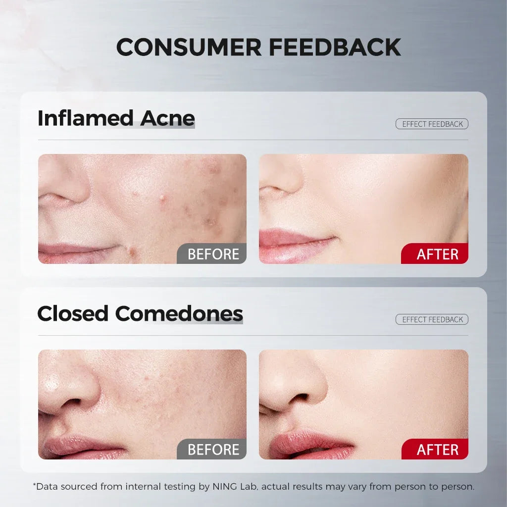 Anti-Acne Clarifying Facial Mask 10 pieces